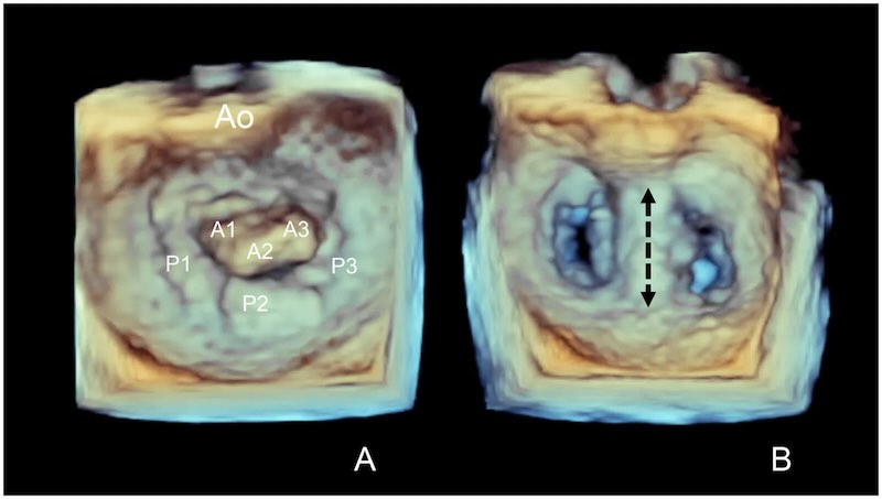 TEER in a mitral valve leaving a double orifice