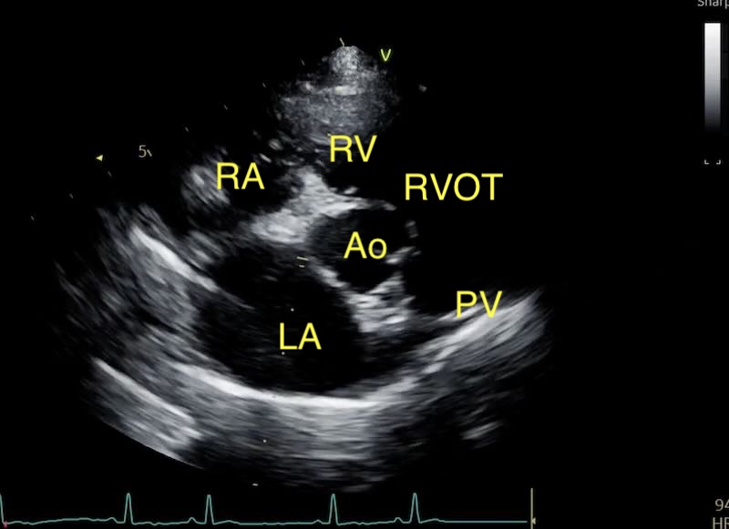 LA:Ao view with annotations