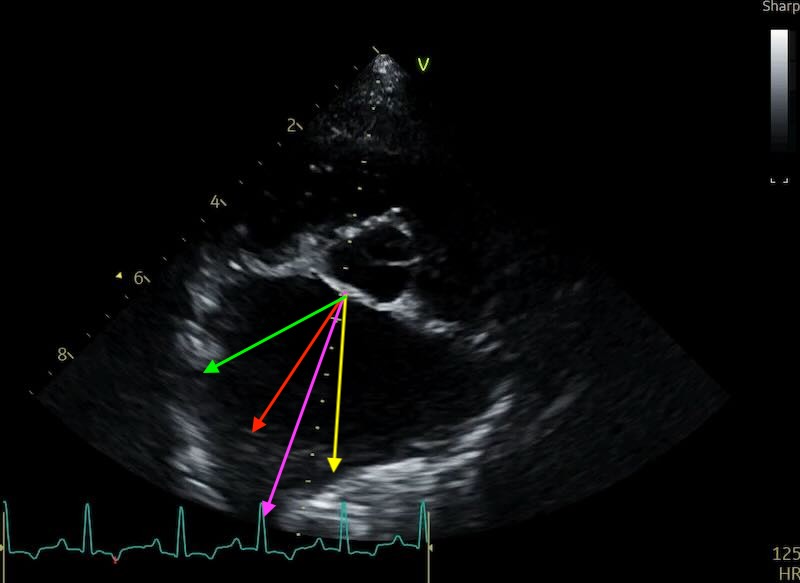 Options to measure around vein when huge
