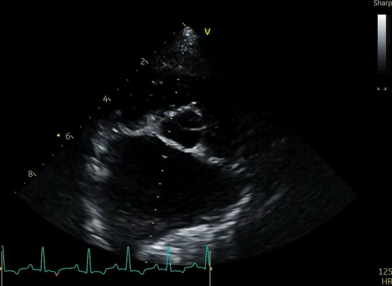 Huge LA:Ao with pulmonary vein