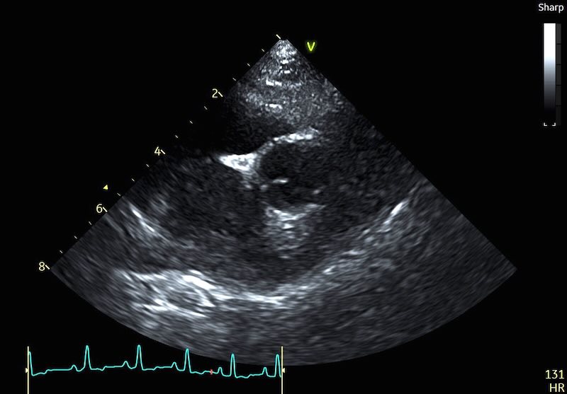 Normal LA:Ao with pulmonary vein