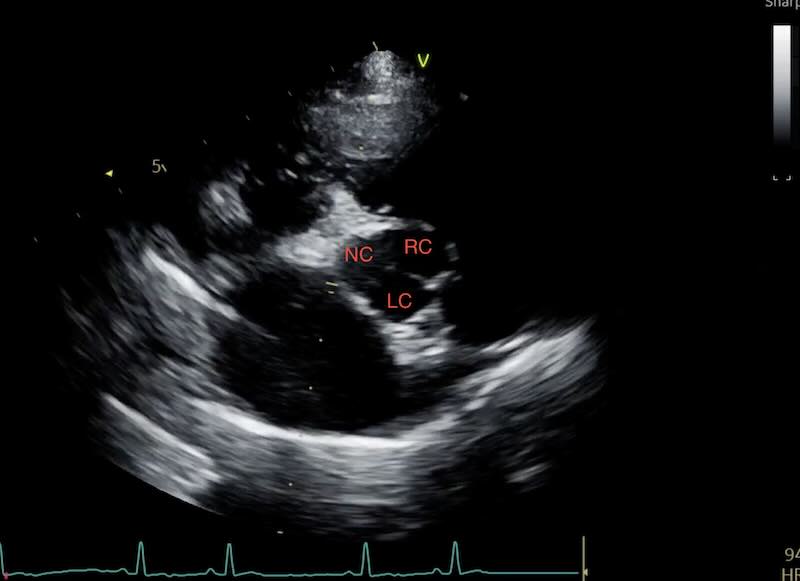 Coronary Cusps LA:Ao