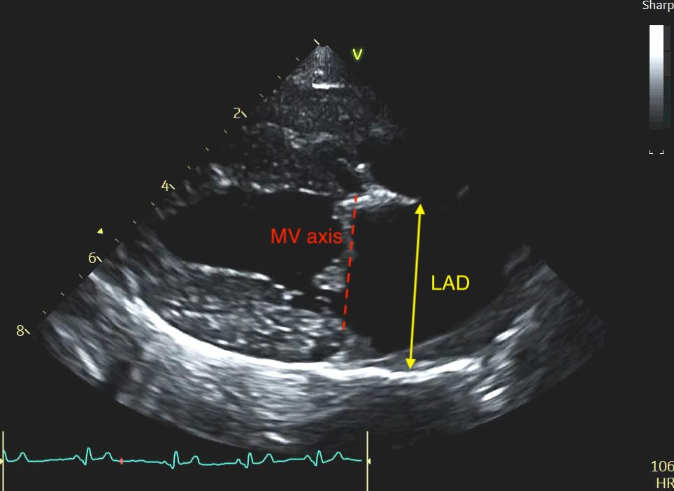 Calliper placement for LAD measurement, aligned with MV axis