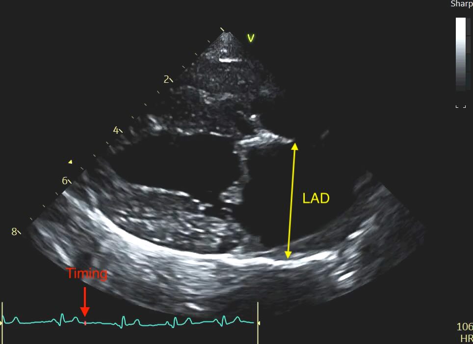 ECG timing for LAD measurement