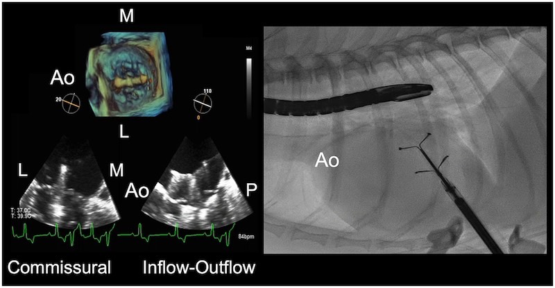 TEER being guided by fluoroscopy and trans-oesophageal echo