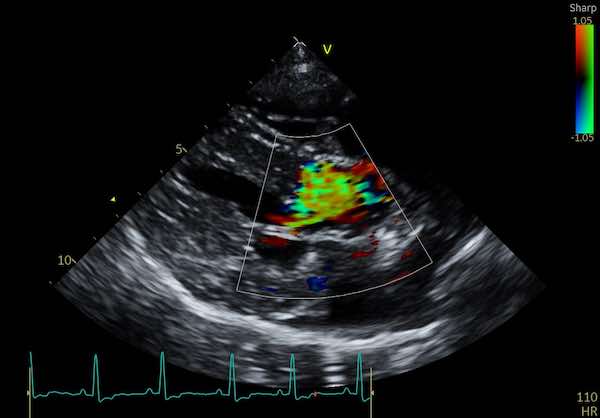 Colour Doppler Turbulence