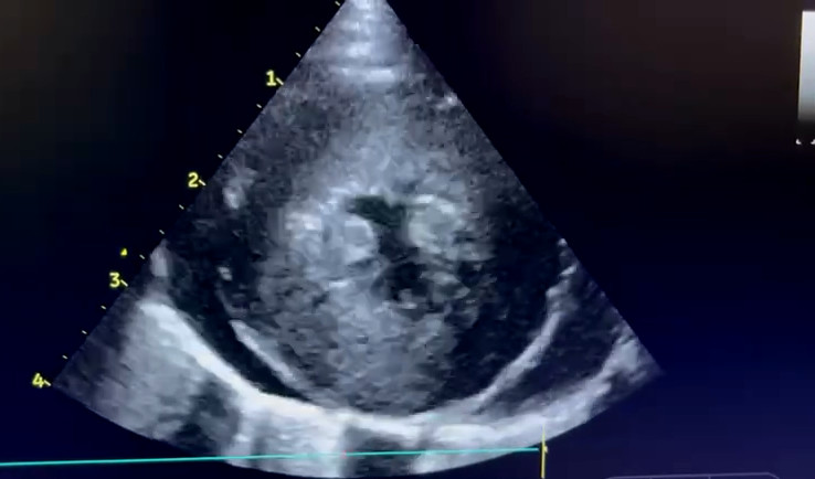Bulls eye view pericardial effusion
