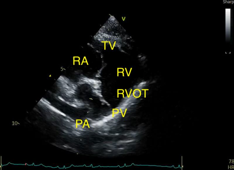 Pulmonic trunk view